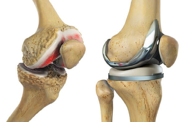 ACL Reconstruction