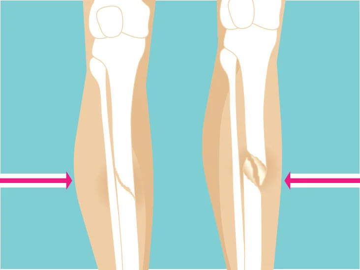 BEST FRACTURE SURGERY