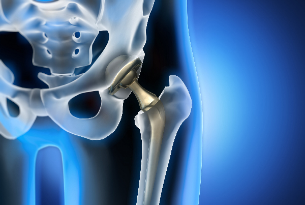 Best Hip Replacement Surgeon