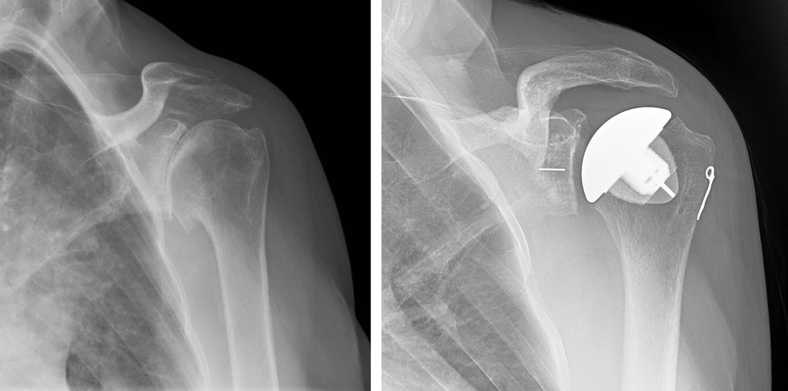 Shoulder Replacement Surgeon