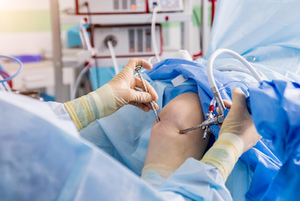 ARTHROSCOPY SURGERY
