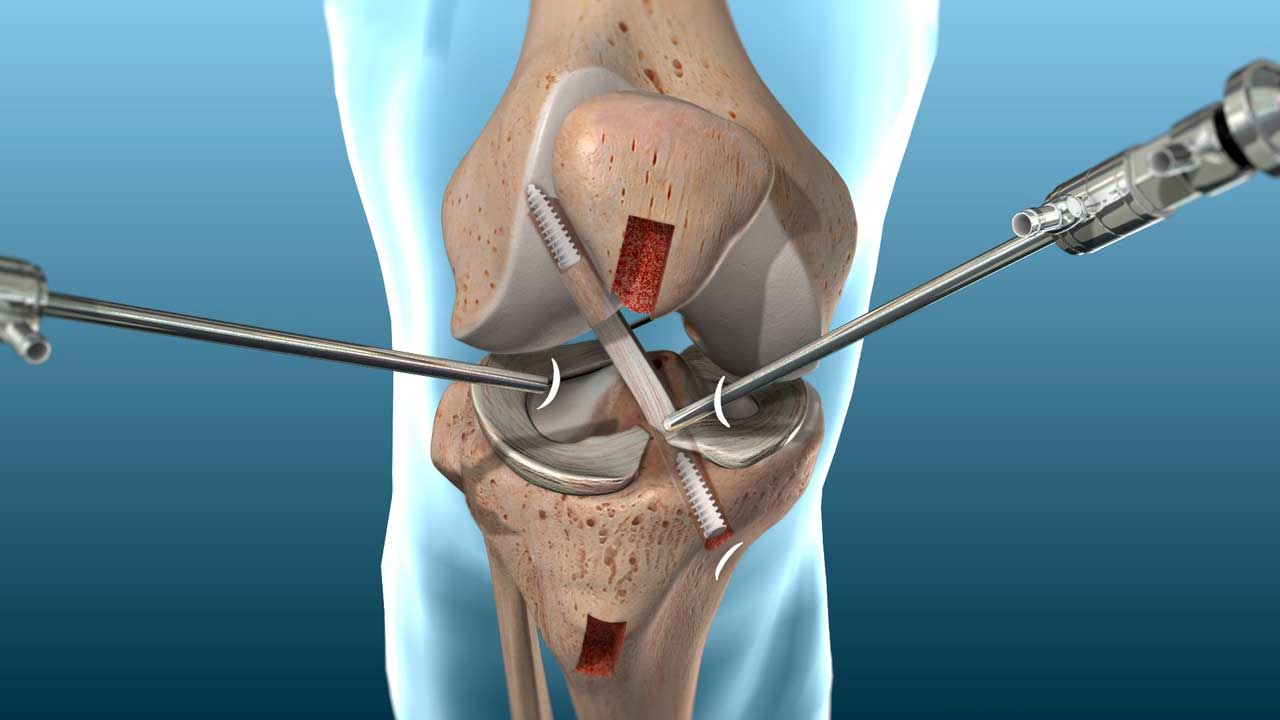 ACL RECONSTRUCTION