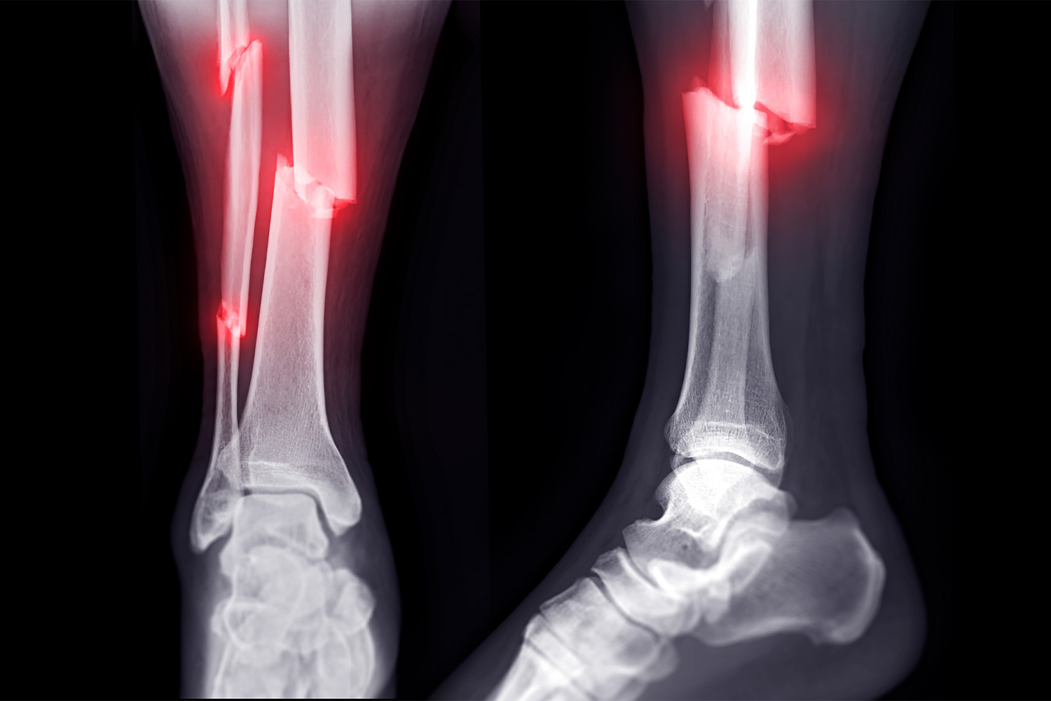 How Are Compound Fractures Treated