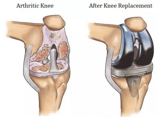 Best Knee Replacement Surgeon