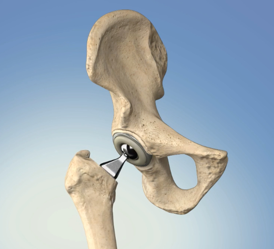 BEST HIP REPLACEMENT SURGEON