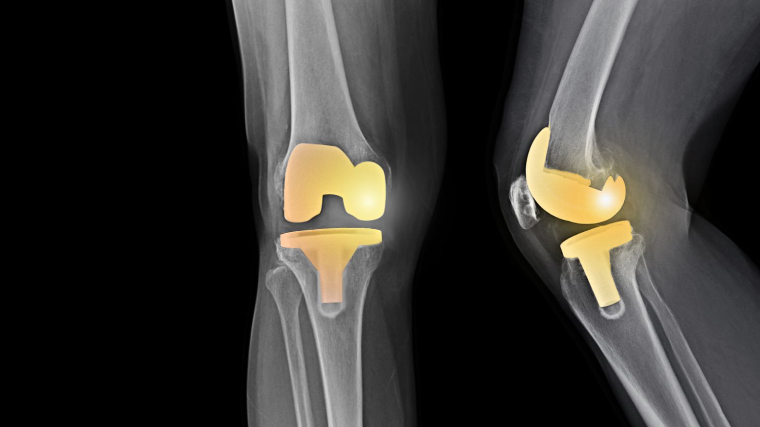 TOTAL KNEE REPLACEMENT