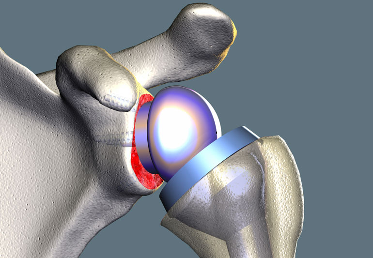 Shoulder Replacement Surgeon