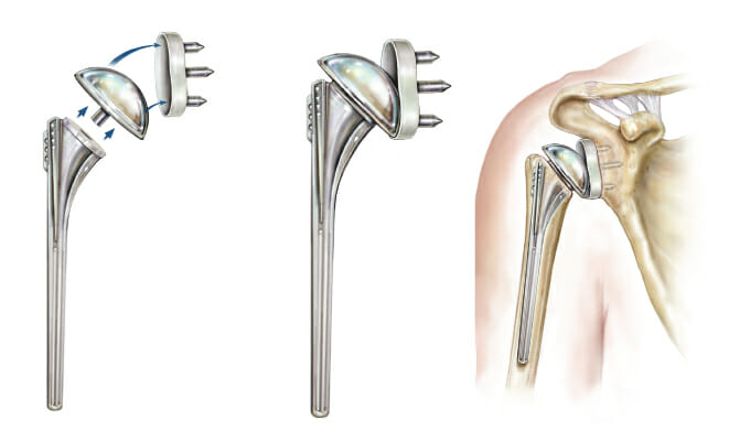 SHOULDER REPLACEMENT SURGEON