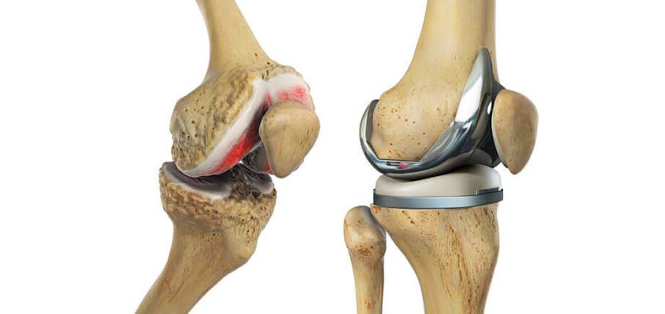 TOTAL KNEE REPLACEMENT